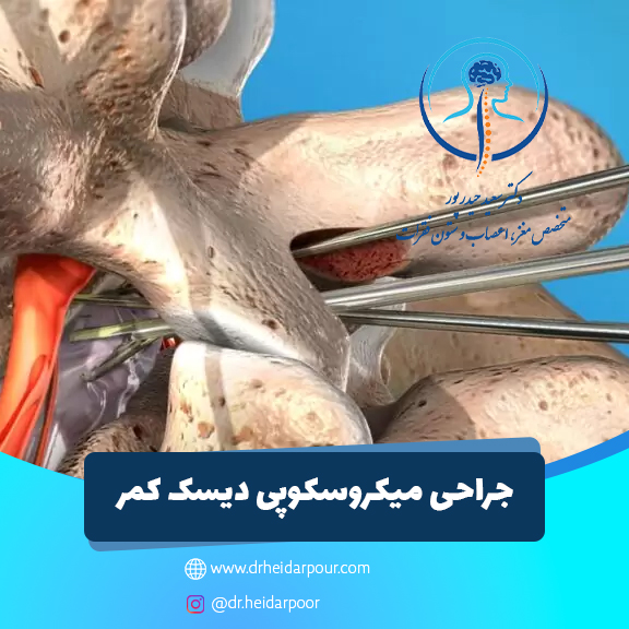 جراحی میکروسکوپی دیسک کمر مشهد